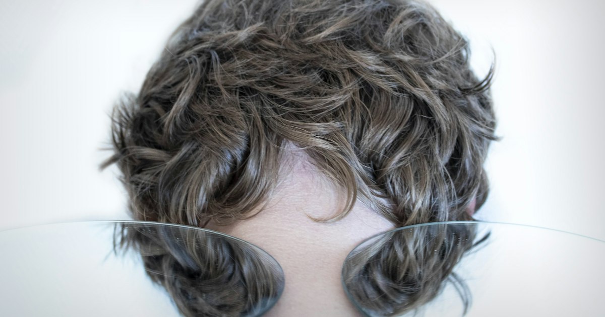 Testosterone propionate and hair: the risk of androgenetic alopecia